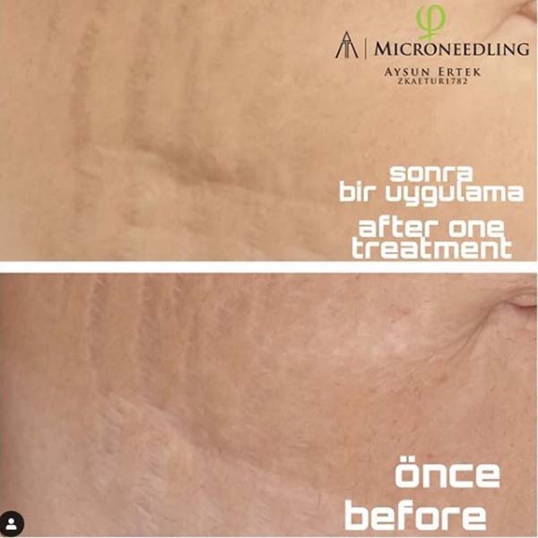 Microneedling - derma pen